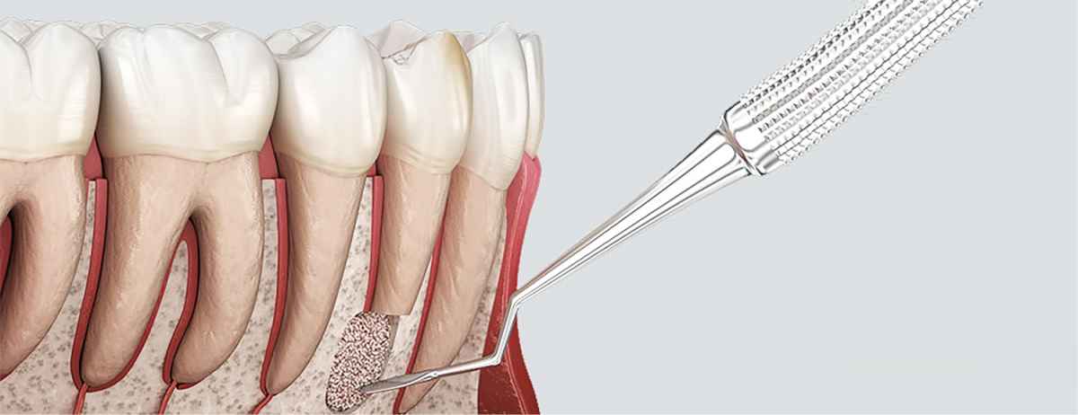 Резекция корня зуба